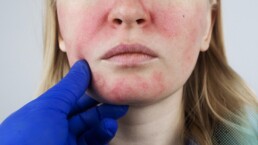 Rosacea Causes, Symptoms, and Effective Management Strategies - CAS Medical