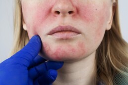 Rosacea Causes, Symptoms, and Effective Management Strategies - CAS Medical