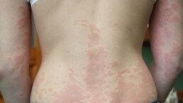 Urticaria