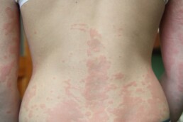 Urticaria